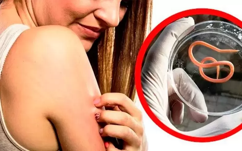 Itching and irritation due to parasites in the body