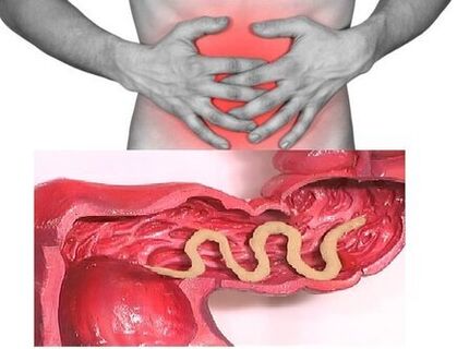 Signs of chronic helminthiasis are dyspeptic bowel disease