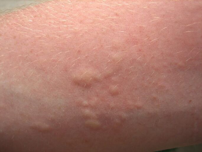 Itchy allergic rashes can be symptoms of ascariasis