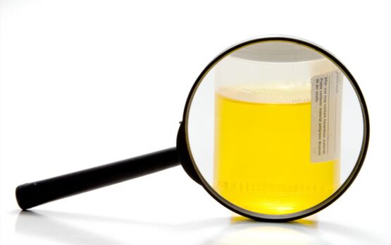 Urinalysis to diagnose schistosomiasis