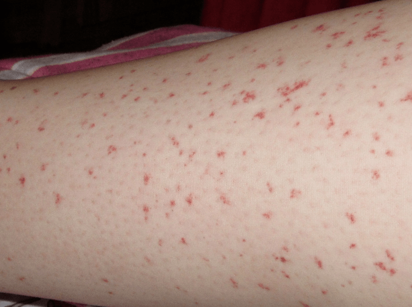 Rash is a sign of an acute stage of a worm infection
